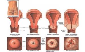 宫颈上皮内瘤样病变,并继续发展成为镜下早期浸润癌