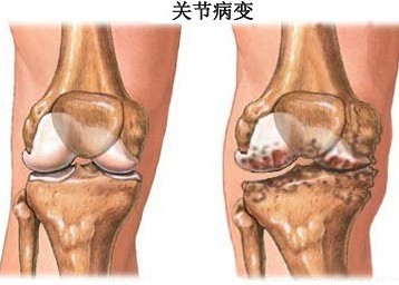 膝关节骨质增生
