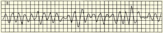 室颤的心电图