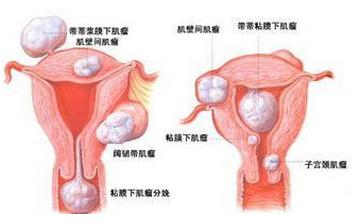 妊娠合并子宫肌瘤-+搜狗百科