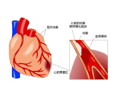 急性心肌梗塞是指冠状动脉急性闭塞,血流中断,持续性缺血缺氧所引起的