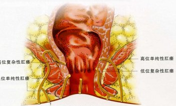 高位复杂性肛瘘
