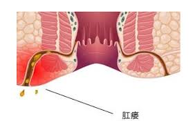 肛瘘的主要症状之一是流脓,脓液不断的流出体外,味臭,患者臭味相随