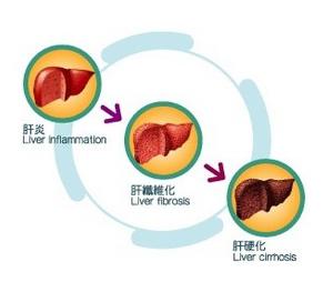 肝硬化