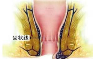 静脉曲张性痔疮
