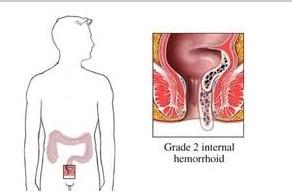 肛门坠胀是什么原因_下腹坠胀是怎么回事_产