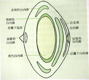 皮质白内障