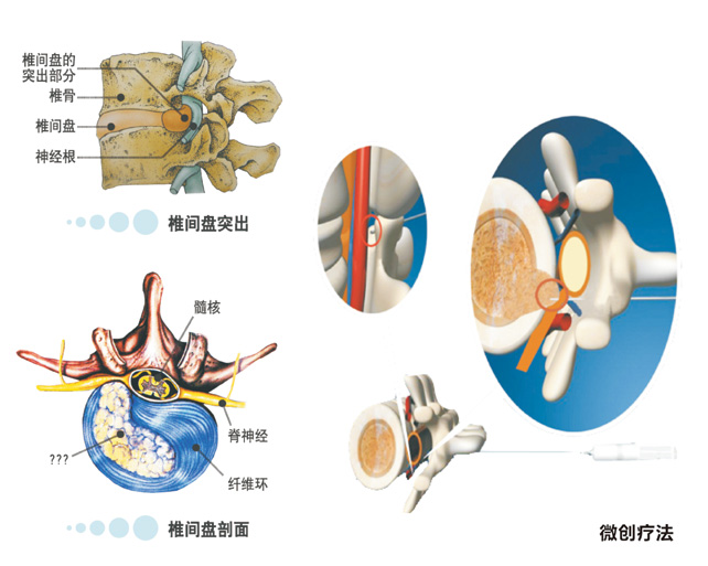 胶原酶腰椎间盘溶解术