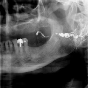 1,慢性复发性腮腺炎:(1)腮腺反复肿胀,不适;(2)导管口轻度红肿,挤压