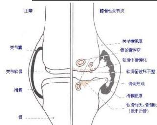 退变性骶髂关节炎-+搜狗百科