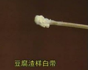    豆腐渣样白带,是典型的霉菌感染,属霉菌性阴道炎类妇科