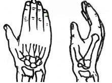 柯莱斯骨折-+搜搜百科