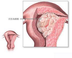 放疗后子宫增大应与宫腔积液,积脓及其他宫体恶性肿瘤区别,分段取子宫