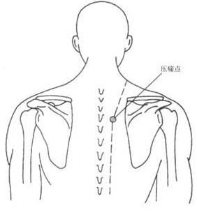 肩胛背神经卡压症-+搜狗百科