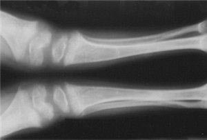 新生儿佝偻病易合并低钙性痉挛