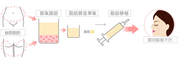 自体脂肪丰下巴