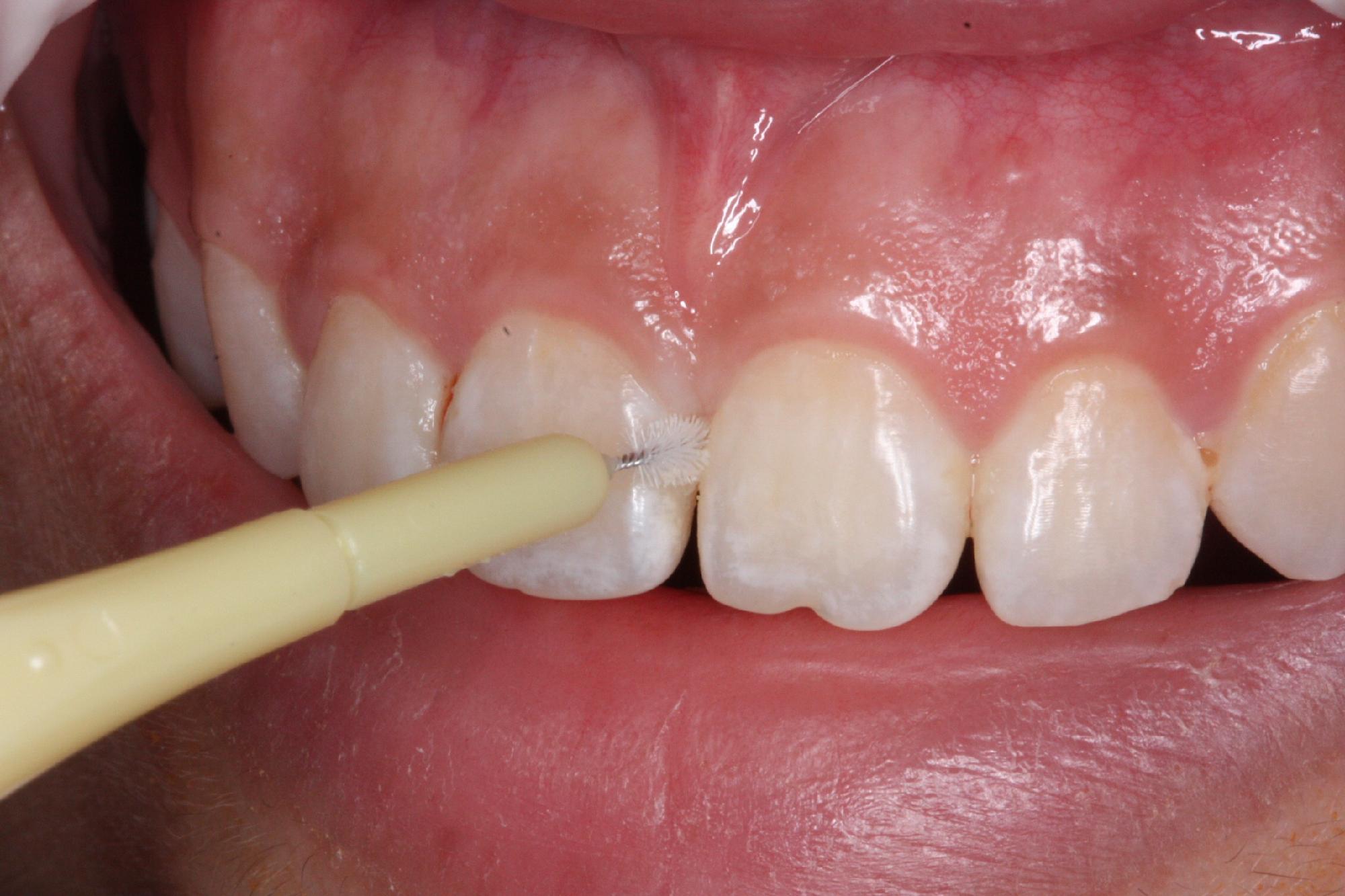 华腾个人护理pesitro热销 5支装L型大牙缝刷 可刷后牙 进口不锈钢_mulongsheng1