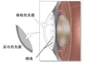 眼角膜