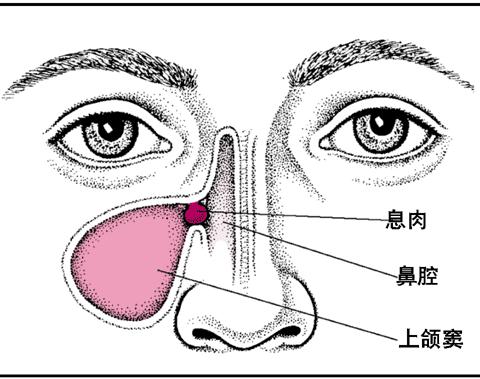 鼻甲肥大