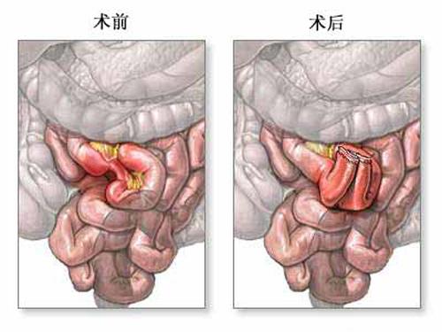 历史版本    小肠内的营养物质和水通过肠粘膜上皮细胞,最后进入血液