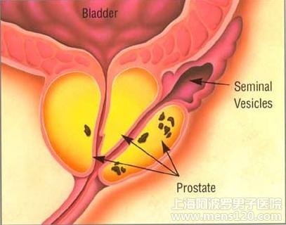 前列腺钙化是一种人体自我修复时的错误表现