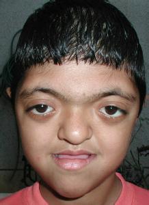 非浸润性突眼_甲亢浸润性突眼_浸润性突眼怎