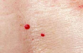 毛细血管痣-毛细血管痣最新资讯,毛细血管痣图