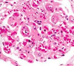 系统性红斑狼疮患者做人流对身体有什么影响