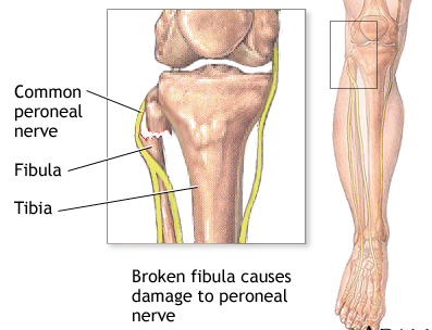 腓总神经损伤+-+搜狗百科