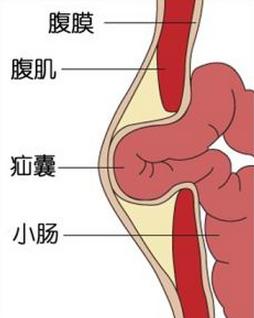 腹壁间疝