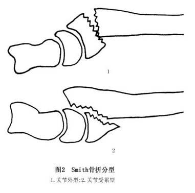 状桡骨远端关节面向掌侧倾斜骨折近端向背侧突出拍腕关节正侧位x线片