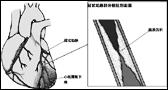 冠状动脉疾病