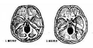 颞骨骨折