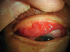 女性沙眼衣原体感染