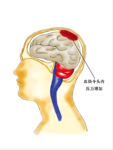 (二)脑出血 好发部位为壳核,丘脑,尾状核头部,中脑,桥脑,小脑,皮质下