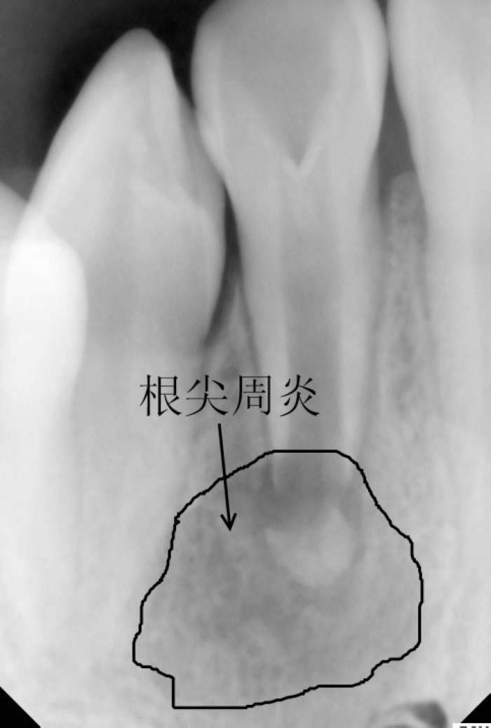 慢性根尖周炎