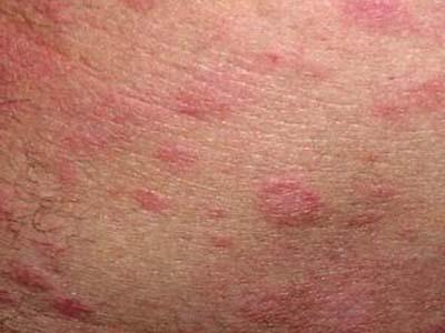 游走性结节性脂膜炎-+搜搜百科