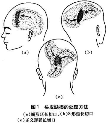  头皮是颅脑部防御外界暴力的表面屏障,具有较大的弹性和韧性