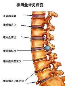 全部版本 历史版本 腰椎小关节的关节囊由纤维结构和滑膜两层组成滑膜