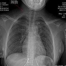 胸腔 胸腔拍片医保