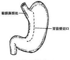 检查对mallory-weiss综合征并不能显示食管贲门部黏膜的撕裂性病变,其