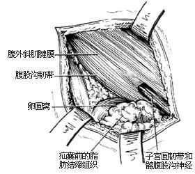 老人腹股沟斜疝