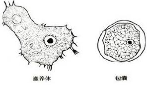 棘阿米巴角膜炎