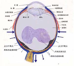 玻璃体液化