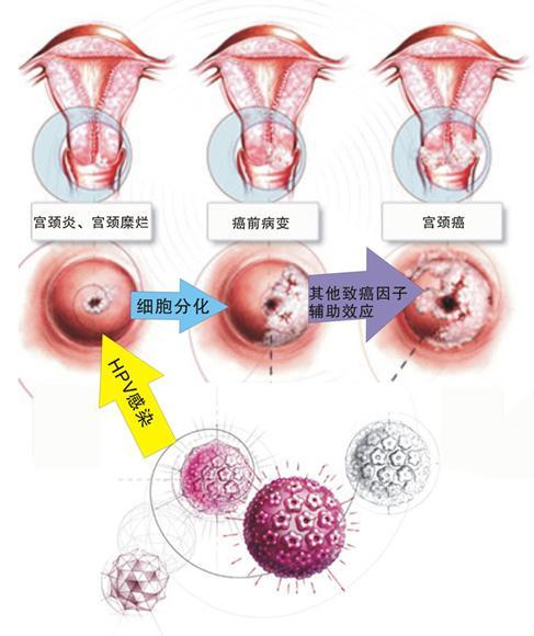 但碘试验为非特异性,如宫颈糜烂,外翻或癌前病变等亦呈阳性. 4.