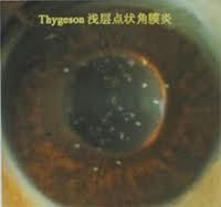 角膜炎的症状表现 怎么治疗角膜炎