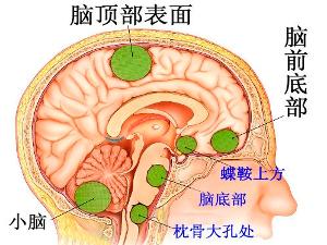 后期因导水管,第四脑室受压,脑桥小脑角池及环池被阻塞而出现颅内压