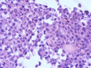 卵巢成熟畸胎瘤