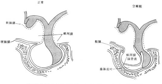 空鞍综合征 - 搜狗百科