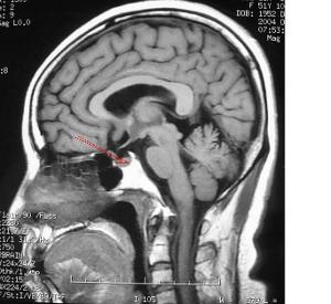 ct显示低密度影,注射造影剂后也无增强,因而易误诊为空鞍,需借助脑池